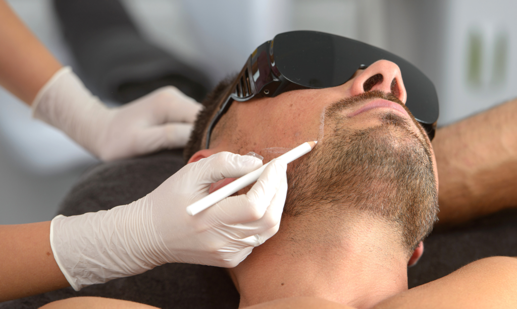 men laser hair removal